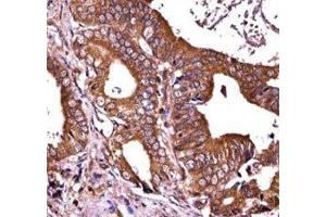 RIPK1 antibody immunohistochemistry analysis in formalin fixed and paraffin embedded human prostate carcinoma. (RIPK1 antibody  (AA 152-180))