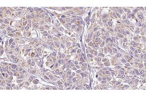 ABIN6278898 at 1/100 staining Human Melanoma tissue by IHC-P. (IL28B antibody)