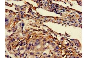 Immunohistochemistry of paraffin-embedded human lung cancer using ABIN7144455 at dilution of 1:100 (Bcl-2 antibody  (AA 31-80))