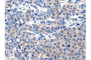 The image on the left is immunohistochemistry of paraffin-embedded Human liver cancer tissue using ABIN7191181(KCNH8 Antibody) at dilution 1/15, on the right is treated with synthetic peptide. (KCNH8 antibody)