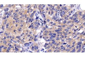 Detection of CASP9 in Human Lymphoma Tissue using Polyclonal Antibody to Caspase 9 (CASP9) (Caspase 9 antibody  (AA 331-416))