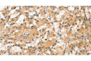 Immunohistochemistry of paraffin-embedded Human thyroid cancer tissue using STAM Polyclonal Antibody at dilution 1:40