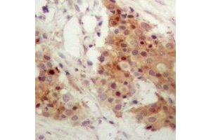 Immunohistochemical analysis of IRF3 (pS385) staining in human breast cancer formalin fixed paraffin embedded tissue section. (IRF3 antibody  (C-Term, pSer385))