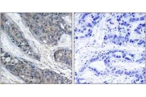 Immunohistochemistry analysis of paraffin-embedded human breast carcinoma, using IRS-1 (Phospho-Ser307) Antibody. (IRS1 antibody  (pSer307))