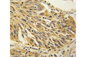 IHC analysis of FFPE human lung carcinoma with IL-1B antibody (IL-1 beta antibody  (AA 148-174))