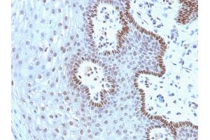 Formalin-fixed, paraffin-embedded human Cervical Carcinoma stained with c-Myc Mouse Monoclonal Antibody (9E10. (Myc Tag antibody  (C-Term))