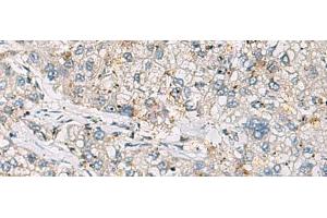 Immunohistochemistry of paraffin-embedded Human liver cancer tissue using ARIH1 Polyclonal Antibody at dilution of 1:30(x200) (ARIH1 antibody)