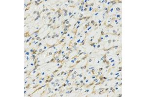 Immunohistochemistry of paraffin-embedded human kidney cancer tissue using MYSM1 antibody at dilution of 1:200 (x400 lens). (MYSM1 antibody  (C-Term))