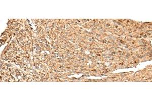 Immunohistochemistry of paraffin-embedded Human liver cancer tissue using RPS12 Polyclonal Antibody at dilution of 1:70(x200) (RPS12 antibody)