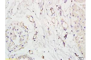 Formalin-fixed and paraffin embedded human colon carcinoma labeled with Anti-SLC5A8 Polyclonal Antibody, Unconjugated (ABIN762521) at 1:200 followed by conjugation to the secondary antibody and DAB staining.