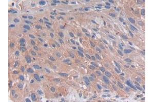 DAB staining on IHC-P; Samples: Human Lung Tissue (PCSK5 antibody  (AA 115-454))