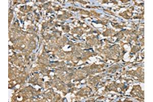 The image on the left is immunohistochemistry of paraffin-embedded Human breast cancer tissue using ABIN7192325(SERPINA11 Antibody) at dilution 1/35, on the right is treated with synthetic peptide. (SERPINA11 antibody)