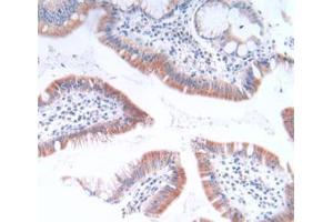 IHC-P analysis of Human Stomach Cancer Tissue, with DAB staining. (GLTP antibody  (AA 2-209))