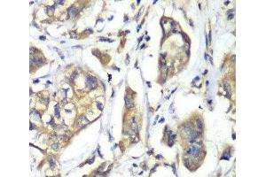 Immunohistochemistry of paraffin-embedded Human liver cancer using NFS1 Polyclonal Antibody at dilution of 1:100 (40x lens). (NFS1 antibody)