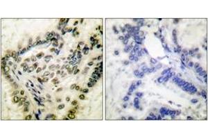 Immunohistochemistry analysis of paraffin-embedded human lung carcinoma, using CREB (Phospho-Ser142) Antibody.