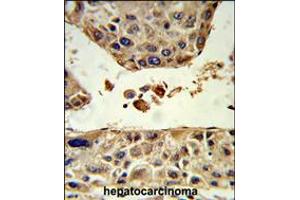 Formalin-fixed and paraffin-embedded human hepatocarcinoma reacted with HPD Antibody , which was peroxidase-conjugated to the secondary antibody, followed by DAB staining. (HPD antibody  (C-Term))