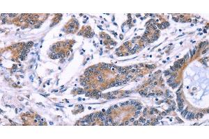 Immunohistochemistry of paraffin-embedded Human colon cancer using SYT4 Polyclonal Antibody at dilution of 1:60
