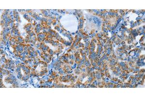 Immunohistochemistry of paraffin-embedded Human thyroid cancer tissue using AGL Polyclonal Antibody at dilution 1:30 (AGL antibody)