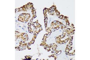 Immunohistochemistry of paraffin-embedded Human thyroid cancer using Septin 8 Rabbit pAb (ABIN7265350) at dilution of 1:100 (40x lens). (Septin 8 antibody  (AA 348-427))