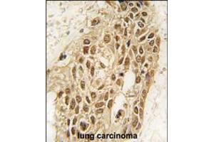 Formalin-fixed and paraffin-embedded human lung carcinoma tissue reacted with Dnmt3a antibody (N-term R46) , which was peroxidase-conjugated to the secondary antibody, followed by DAB staining. (DNMT3A antibody  (N-Term))