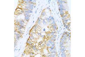 Immunohistochemistry of paraffin-embedded human colon carcinoma using BMP2 antibody at dilution of 1:100 (40x lens). (BMP2 antibody)