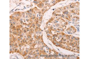 Immunohistochemistry of Human lung cancer using GNA11 Polyclonal Antibody at dilution of 1:40 (GNA11 antibody)
