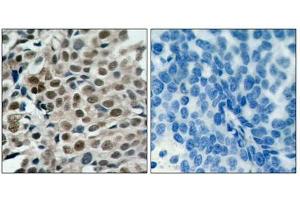 Immunohistochemical analysis of paraffin-embedded human breast carcinoma tissue using FKHRL1 (phospho-Ser253) antibody. (FOXO3 antibody  (pSer253))