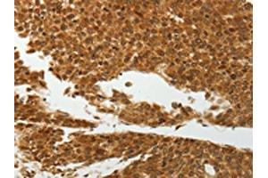 The image on the left is immunohistochemistry of paraffin-embedded Human liver cancer tissue using ABIN7192598(SOCS7 Antibody) at dilution 1/30, on the right is treated with synthetic peptide.