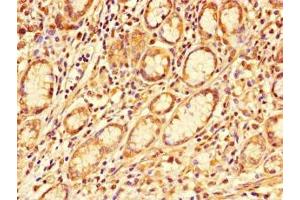 Immunohistochemistry of paraffin-embedded human gastric cancer using ABIN7163856 at dilution of 1:100 (GALNT11 antibody  (AA 420-606))