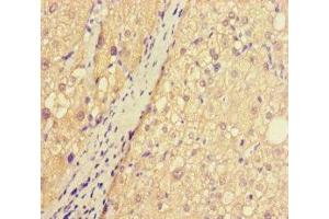 Immunohistochemistry of paraffin-embedded human liver cancer using ABIN7144175 at dilution of 1:100 (ASB1 antibody  (AA 1-300))