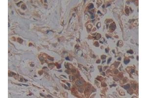 Detection of PKCi in Human Breast cancer Tissue using Polyclonal Antibody to Protein Kinase C Iota (PKCi) (PKC iota antibody  (AA 375-596))