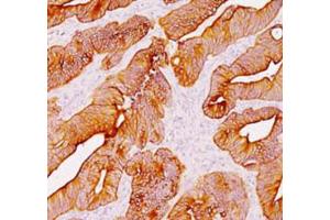 Immunohistochemical staining (Formalin-fixed paraffin-embedded sections) analysis of human colon with Pan Cytokeratin monoclonal antibody, clone AE1 + AE3  at 1:200 using peroxidase-conjugate and DAB chromogen. (Keratin 77 antibody)