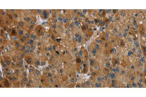 Immunohistochemistry of paraffin-embedded Human liver cancer tissue using HSD17B14 Polyclonal Antibody at dilution 1:40 (HSD17B14 antibody)