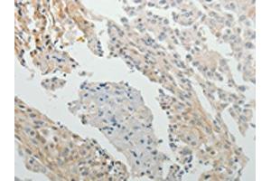 The image on the left is immunohistochemistry of paraffin-embedded Human cervical cancer tissue using ABIN7131158(SPATA17 Antibody) at dilution 1/15, on the right is treated with fusion protein. (SPATA17 antibody)