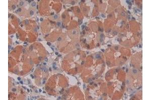 Detection of IL28A in Human Stomach cancer Tissue using Monoclonal Antibody to Interleukin 28A (IL28A) (IL28A antibody  (AA 26-200))