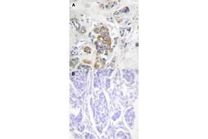 Immunohistochemical staining (Formalin-fixed paraffin-embedded sections) of human breast cancer tissue with ITGB4 (phospho Y1510) polyclonal antibody  without blocking peptide (A) or preincubated with blocking peptide (B) under 1:50-1:100 dilution. (Integrin beta 4 antibody  (pTyr1510))
