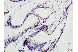 Formalin-fixed and paraffin embedded human colon carcinoma labeled with Anti-beta Defensin 1 Polyclonal Antibody, Unconjugated  at 1:200 followed by conjugation to the secondary antibody and DAB staining. (beta Defensin 1 antibody  (AA 33-68))