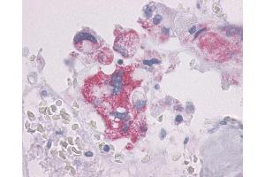 Anti-PTHR / PTHR1 antibody IHC of human Bone, Giant Cell Tumor. (PTH1R antibody  (N-Term))