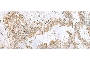 Immunohistochemistry of paraffin-embedded Human breast cancer tissue using PCBD1 Polyclonal Antibody at dilution of 1:60(x200) (PCBD1 antibody)