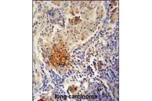 TYROBP Antibody immunohistochemistry analysis in formalin fixed and paraffin embedded human lung carcinoma followed by peroxidase conjugation of the secondary antibody and DAB staining. (TYROBP antibody  (C-Term))