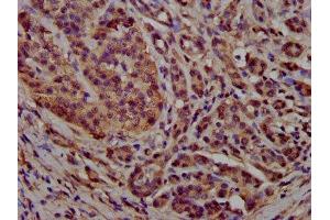IHC image of ABIN7164816 diluted at 1:300 and staining in paraffin-embedded human pancreatic cancer performed on a Leica BondTM system.
