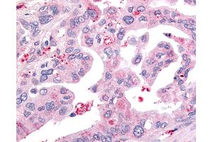 Anti-USP4 / UNP antibody IHC of human Pancreas, Carcinoma. (USP4 antibody  (Internal Region))