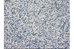 Immunohistochemical staining of paraffin-embedded Adenocarcinoma of colon tissue using anti-LTA4H mouse monoclonal antibody. (LTA4H antibody)