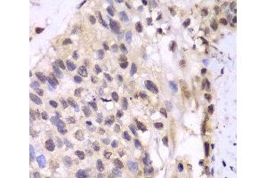 Immunohistochemistry of paraffin-embedded Human lung cancer using PSMA6 Polyclonal Antibody at dilution of 1:100 (40x lens). (PSMA6 antibody)