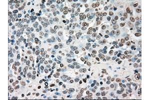 Immunohistochemical staining of paraffin-embedded colon tissue using anti-CHEK2mouse monoclonal antibody. (CHEK2 antibody)