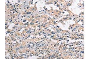 The image on the left is immunohistochemistry of paraffin-embedded Human thyroid cancer tissue using ABIN7190272(CLDN11 Antibody) at dilution 1/25, on the right is treated with synthetic peptide. (Claudin 11 antibody)