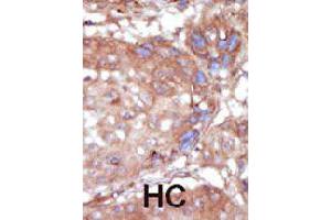 Formalin-fixed and paraffin-embedded human hepatocellular carcinoma tissue reacted with TNK2 polyclonal antibody  , which was peroxidase-conjugated to the secondary antibody, followed by AEC staining. (TNK2 antibody  (C-Term))