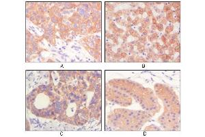 Immunohistochemical analysis of paraffin-embedded human lung squamous cell carcinoma (A),normal hepatocyte (B), colon adenocacinoma? (Cytokeratin 1 antibody)