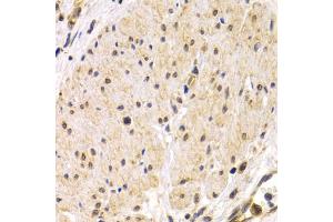 Immunohistochemistry of paraffin-embedded human stomach cancer using TMPRSS2 antibody. (TMPRSS2 antibody)