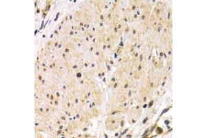 Immunohistochemistry of paraffin-embedded human stomach cancer using TMPRSS2 antibody.